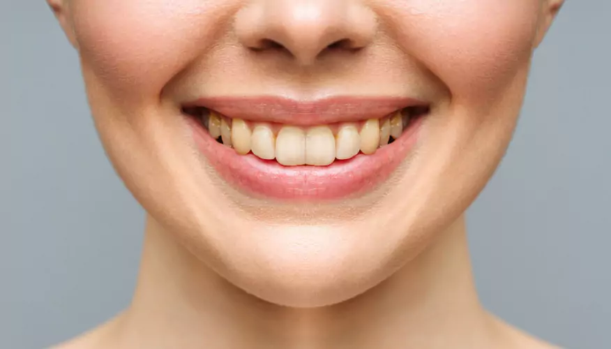 Before dental transformation